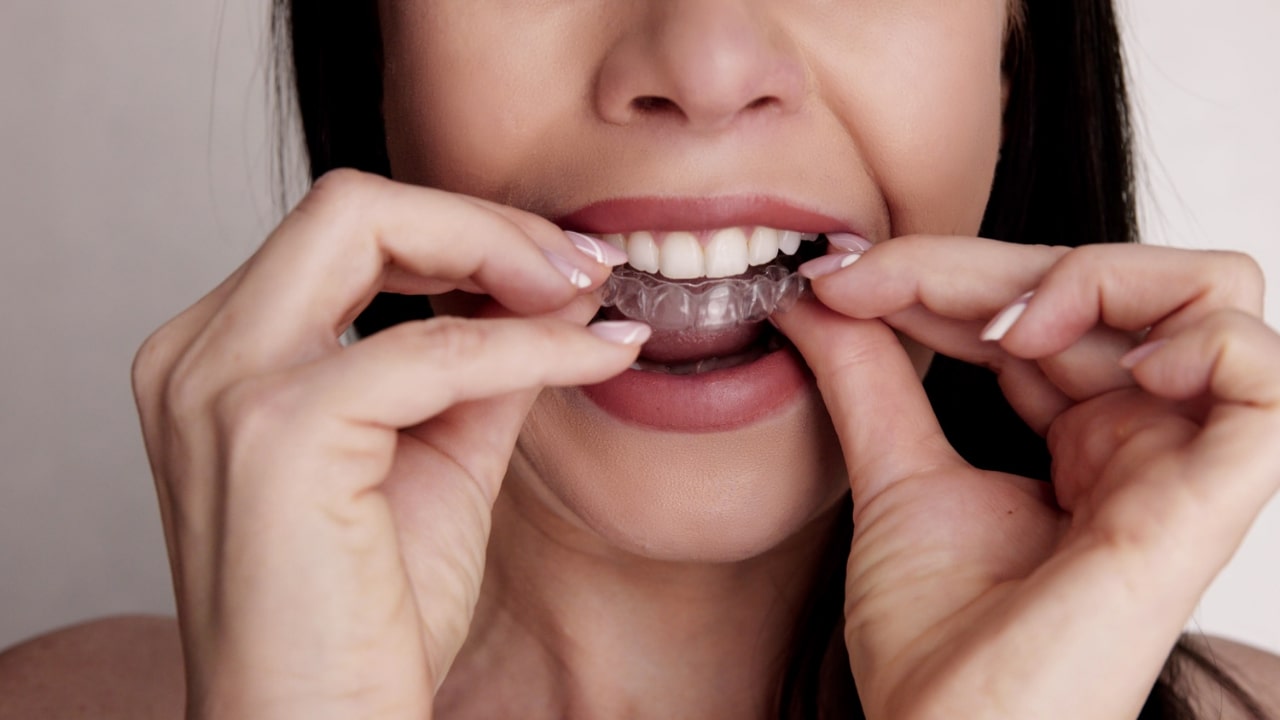 dentalni alajneri folije za ispravljanje zuba