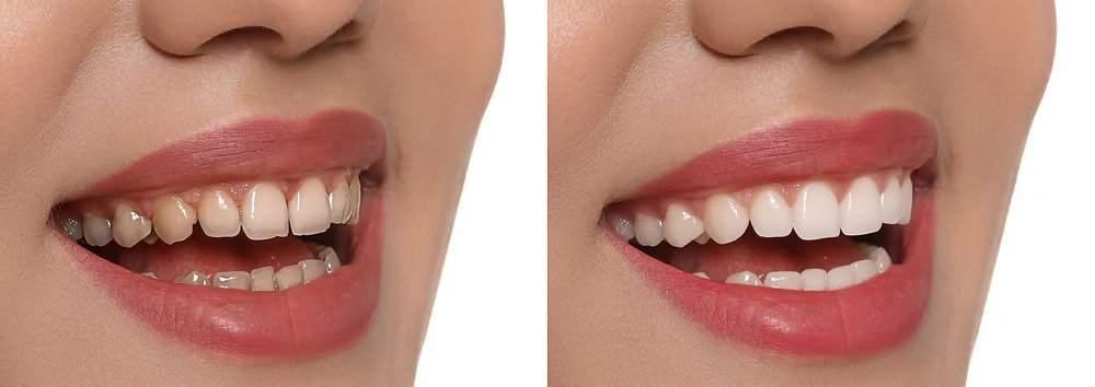 keramicke krunice pre i posle