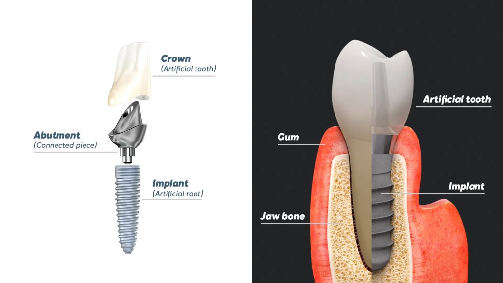 zubni implant