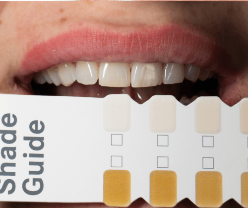 Izbeljivanje zuba – nega posle tretmana i kako održati zube&nbsp;belim