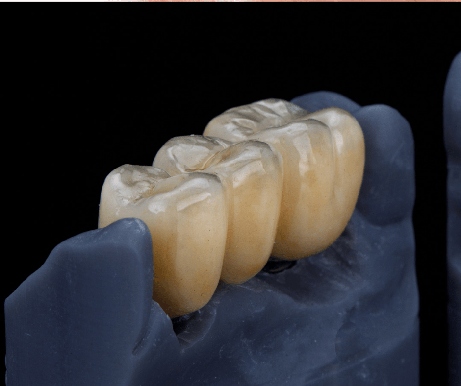 Šta Je Zubni Most i Kada Je&nbsp;Potreban?