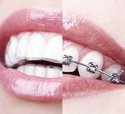 dentalni alajneri, folije za ispravljanje zuba