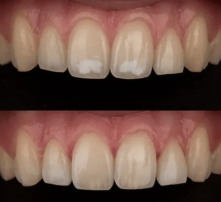 uklanjanje belih mrlja sa zuba