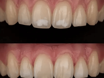 Bele mrlje na zubima: Kako ih trajno ukloniti bez bušenja uz pomoć Icon&nbsp;tretmana