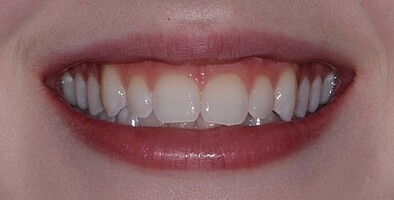 icon tretman uklanjanje belih mrlja