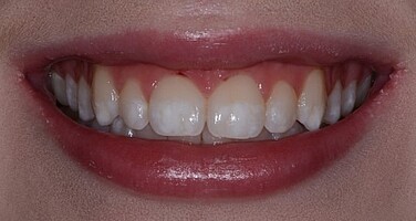 icon tretman uklanjanje belih mrlja