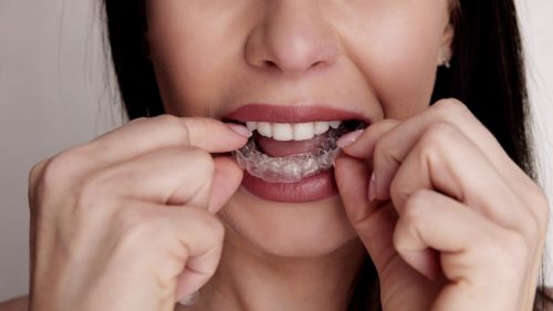 Koliko se nose folije za ispravljanje&nbsp;zuba?