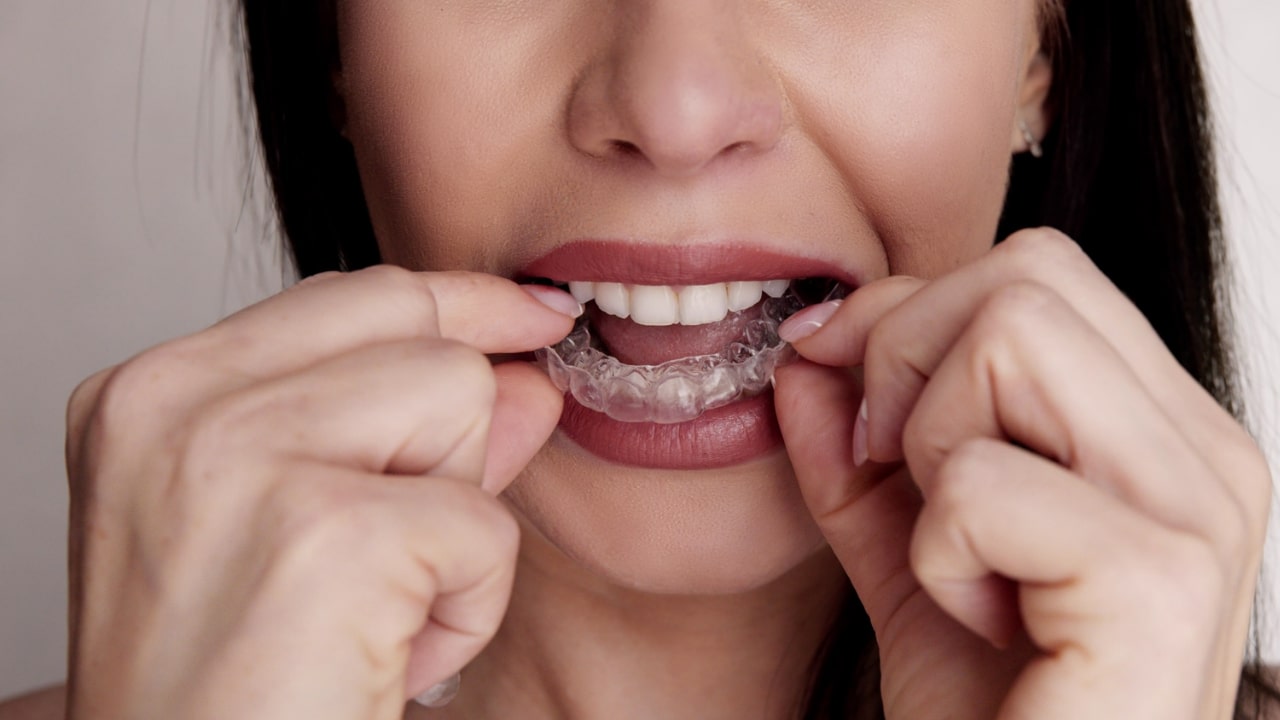 Dentalni Alajneri (Providne Folije Za Ispravljanje Zuba )