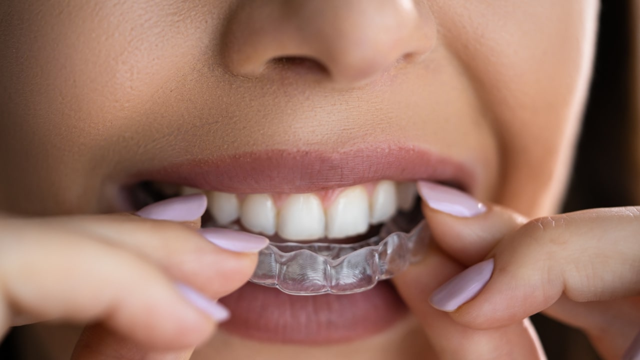 kucno izbeljivanje zuba folijama