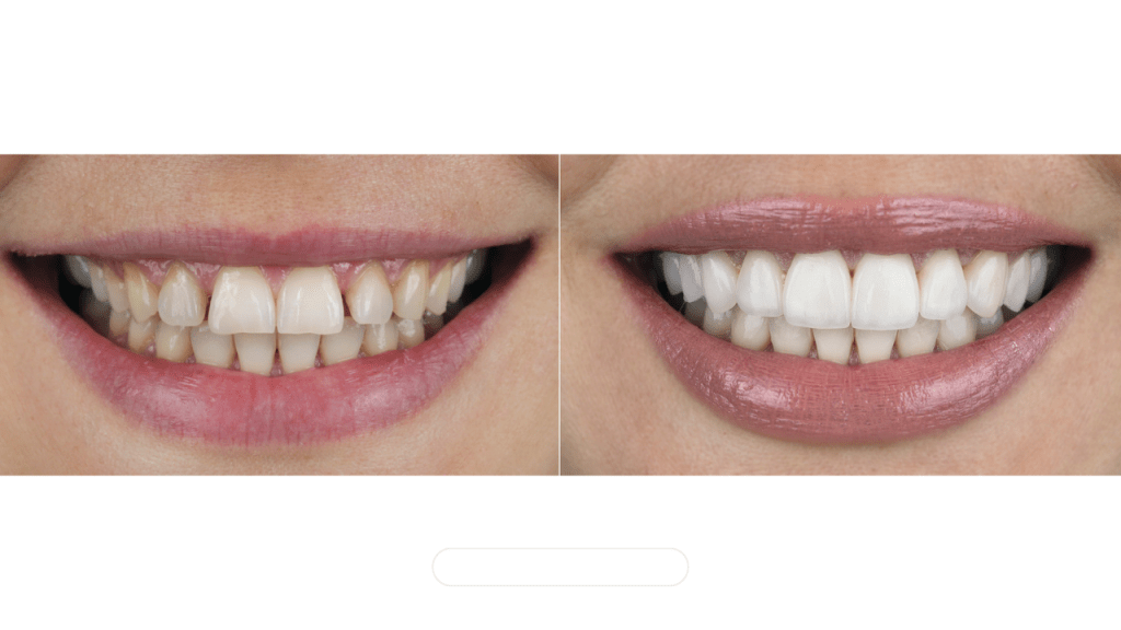 smile makeover keramicke krunice