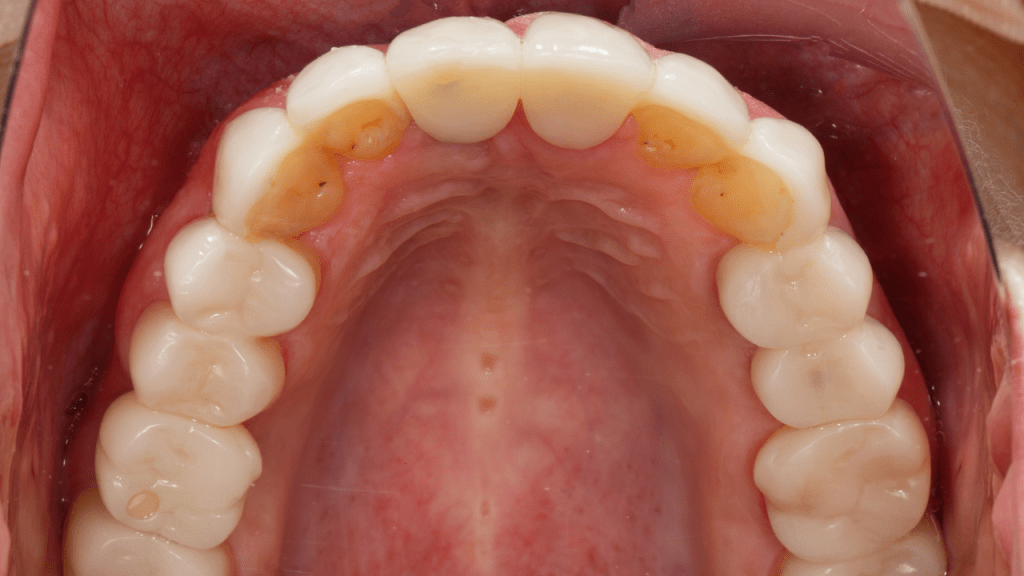 keramicke krunice i mostovi