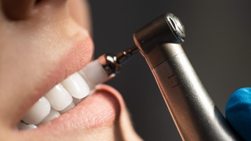 gingivitis parodontopatija uklanjanje kamenca