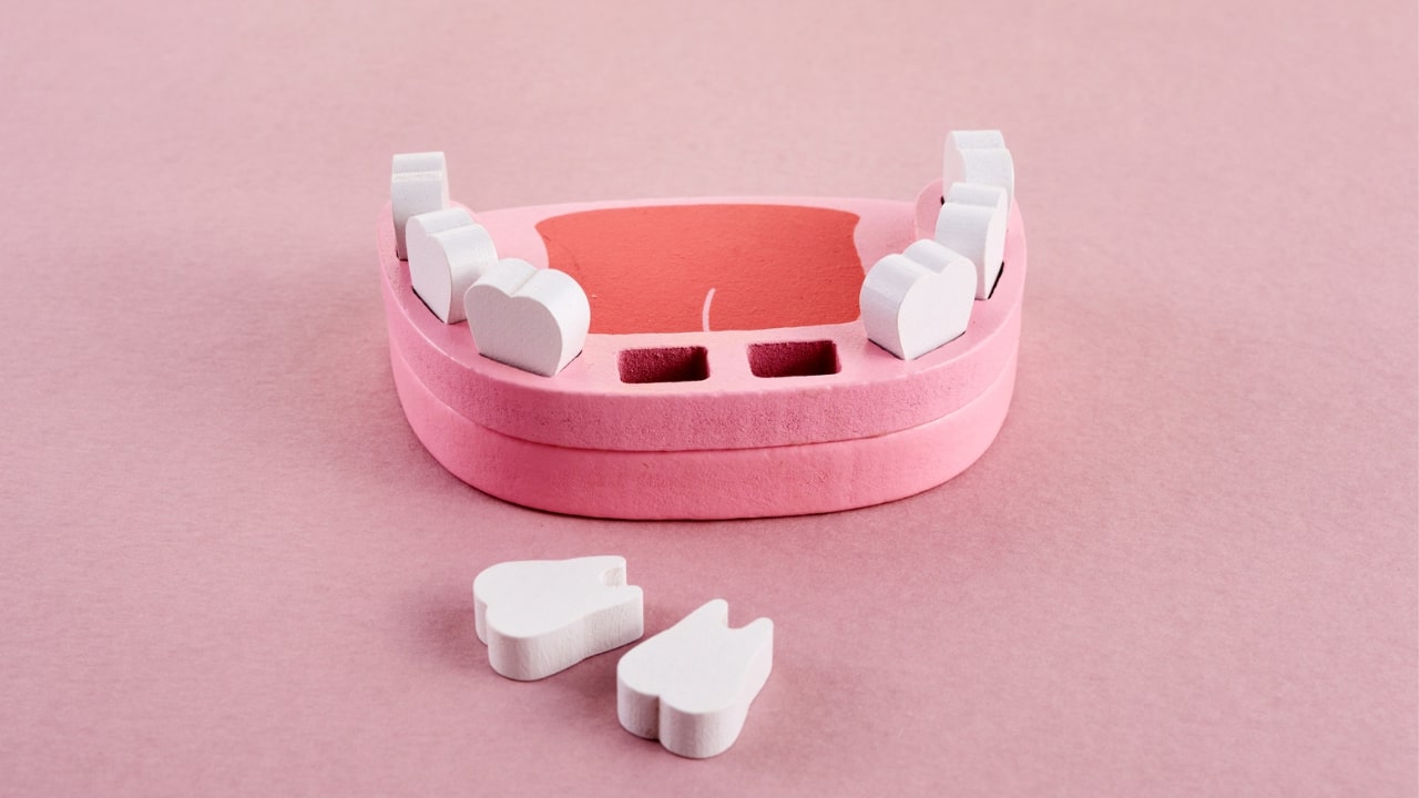 gubitak zuba zbog parodontopatije