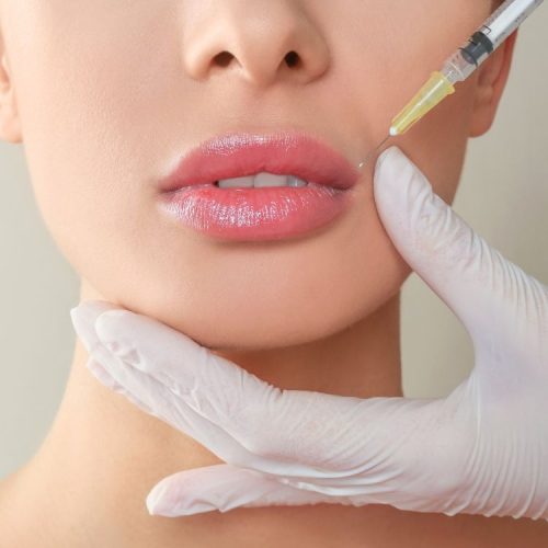 botox lip flip