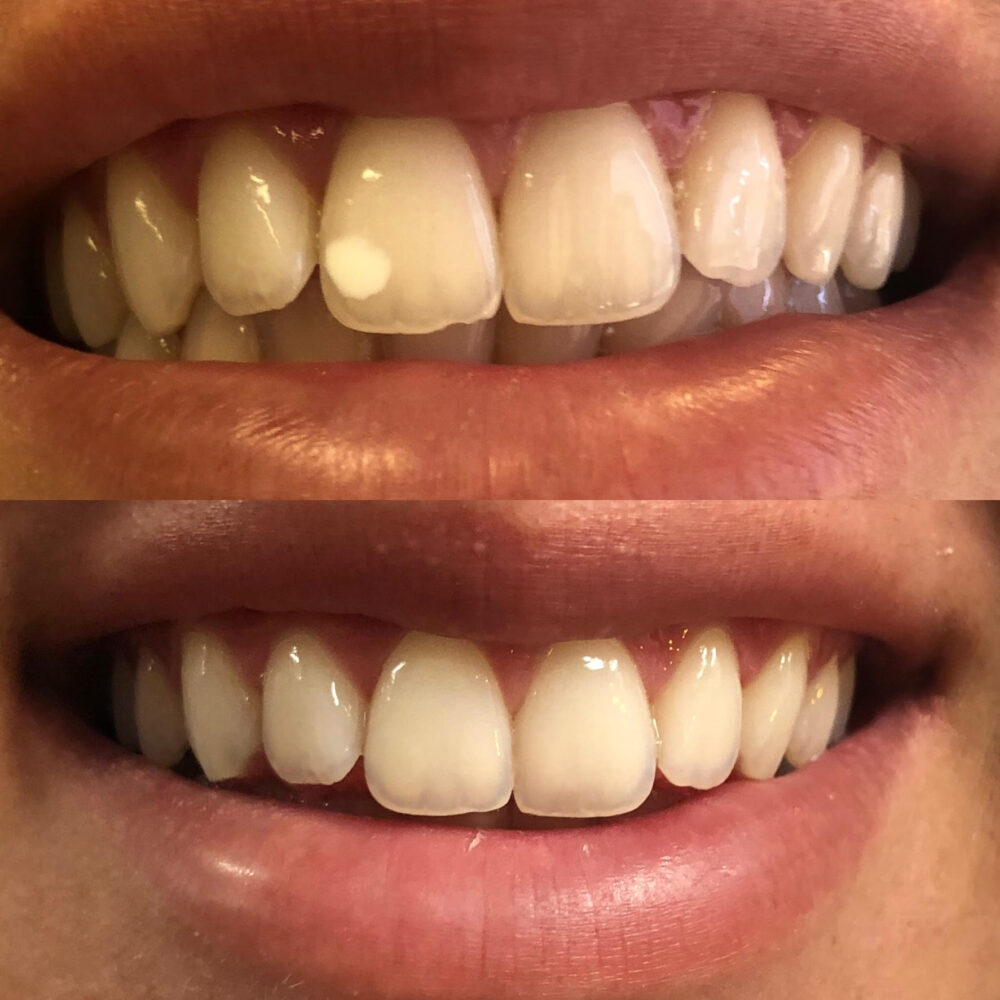 icon tretman uklanjanje belih mrlja