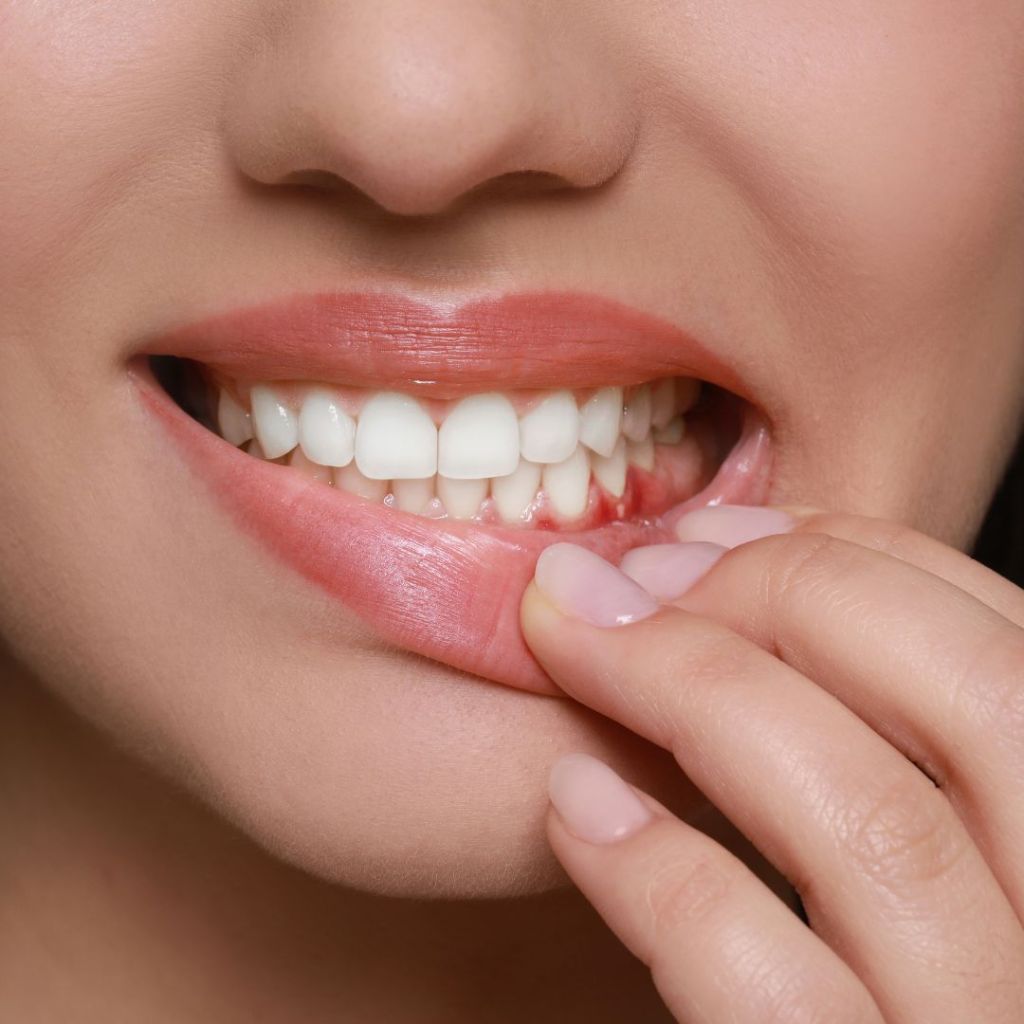 gingivitis parodontopatija uklanjanje kamenca