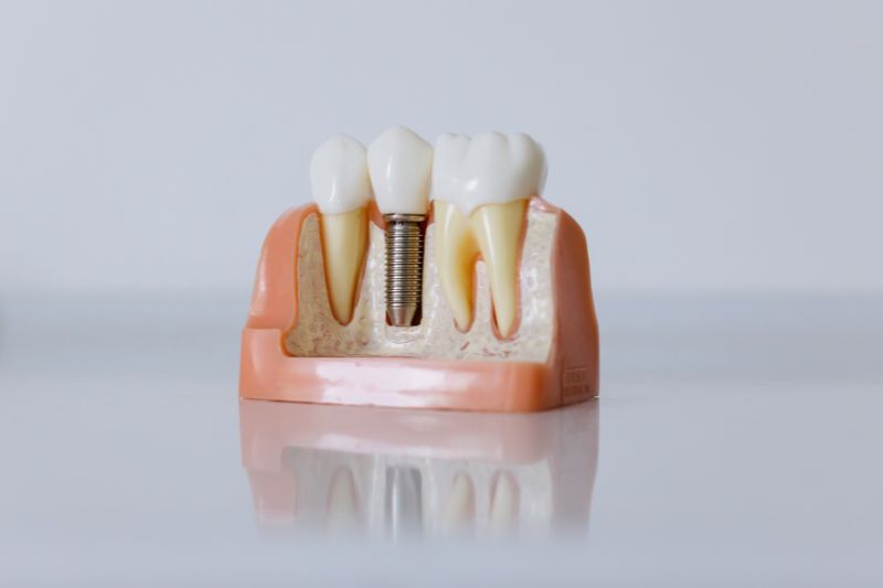 ugradnja zubnog implanta
