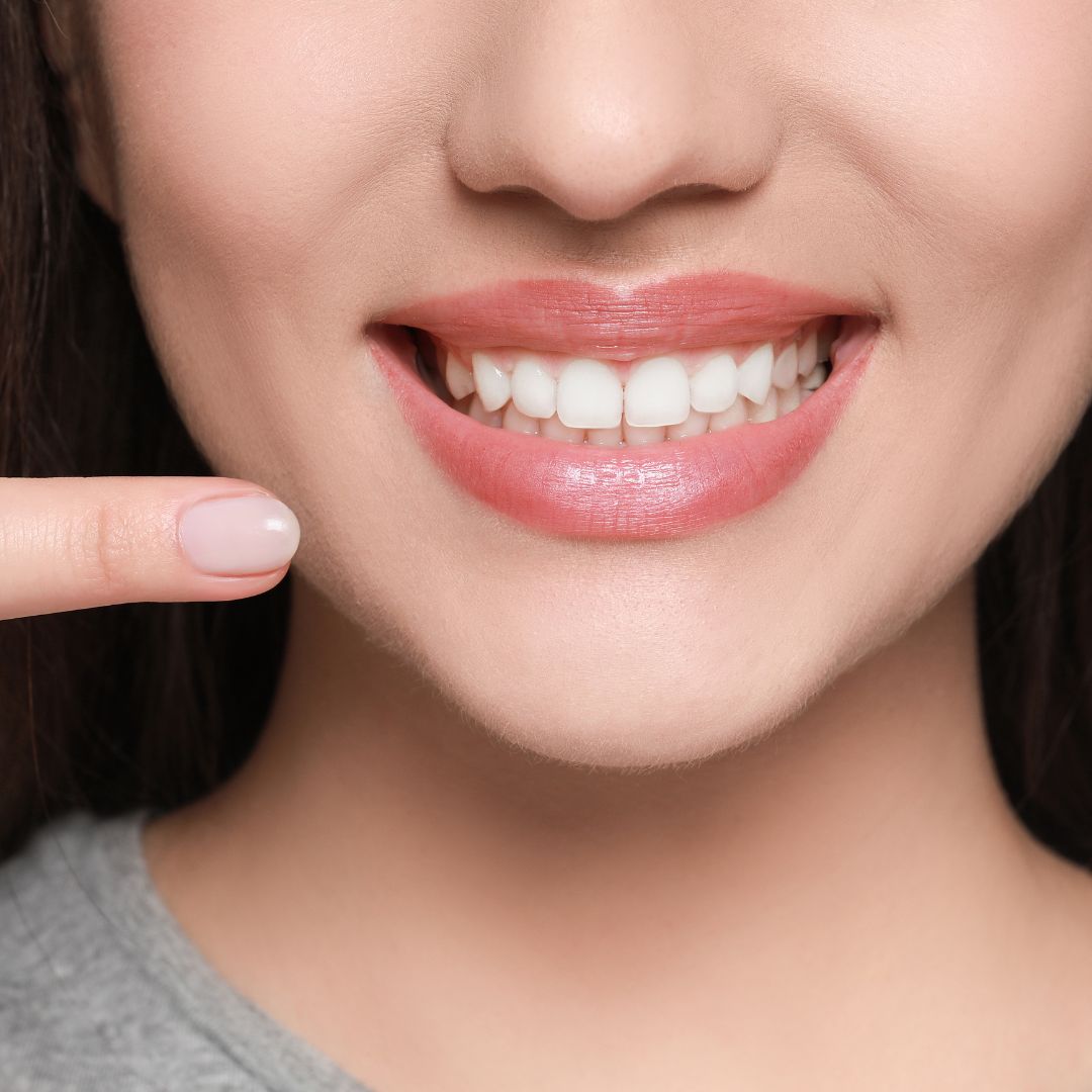 gingivitis parodontopatija uklanjanje kamenca