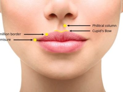 Kako korigovati asimetriju usana hijaluronskim&nbsp;filerima?