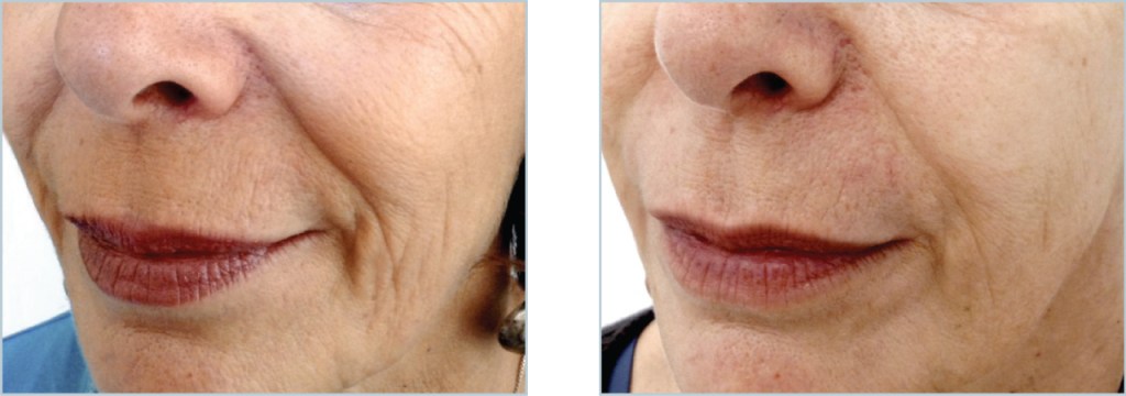 Koji su najbolji tretmani za korekciju nazolabijalnih&nbsp;bora?