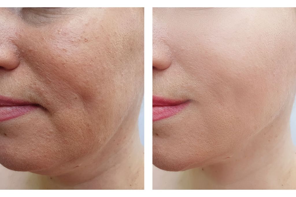 Koji su najbolji tretmani za zatezanje kože&nbsp;lica?