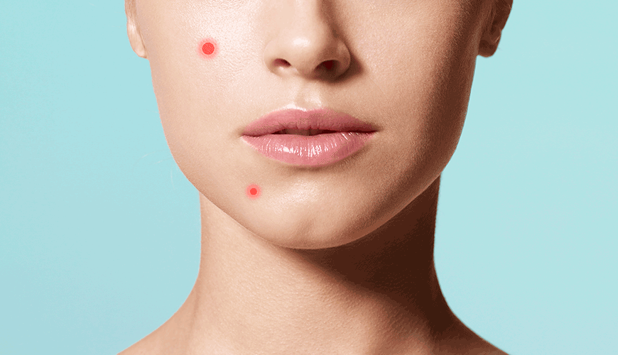 acne and scarring