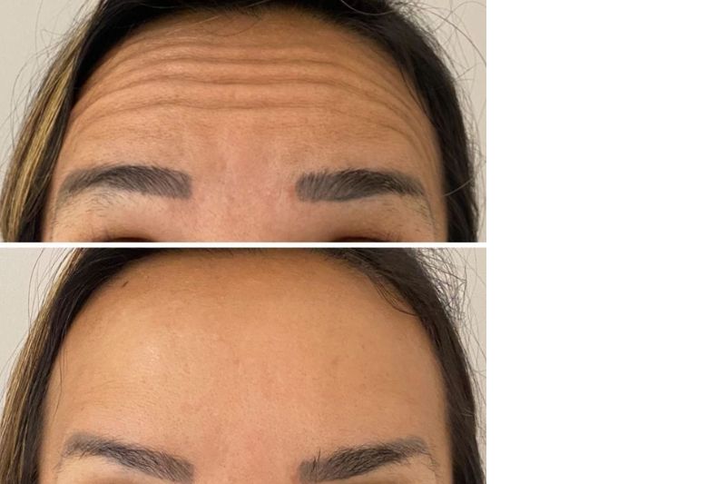 Šta raditi ako botoks ne deluje kako ste&nbsp;očekivali?