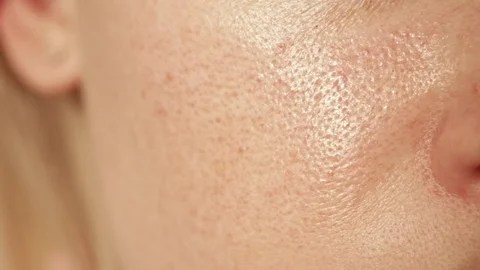 tretmani lica za masnu kozu