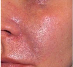 komplikacije hijaluronskih filera